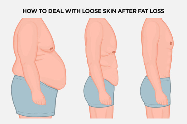How to Deal With Loose Skin After Fat Loss
