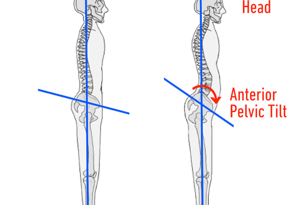 What Is Anterior Pelvic Tilt what-is-anterior-pelvic-tilt
